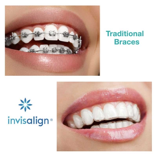 Clear Aligners Treatment in Surat, Invisible Aligners Treatment Cost in  Gujarat